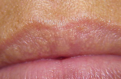 White Dry Patch On Tongue