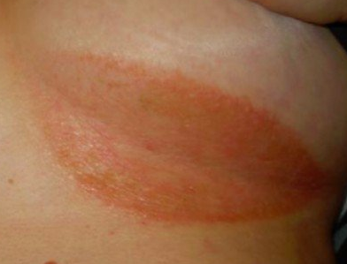 Intertrigo rash under woman's breast - Stock Image - M180/0072 - Science  Photo Library