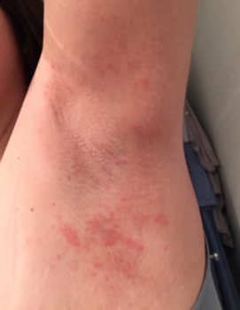 quick red with white surrounding itrash in fold of thigh