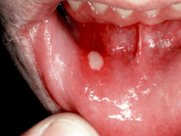 sore inside mouth