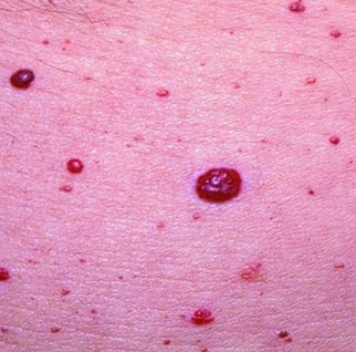 raised pinpoint red dots on skin