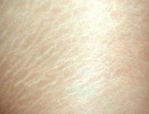 stretch marks on arms