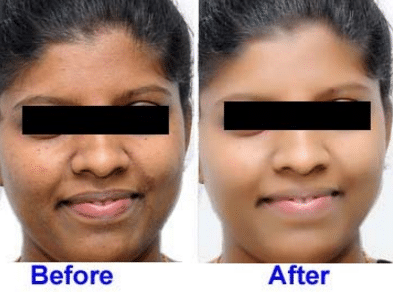 best skin lightening pills picture before and after