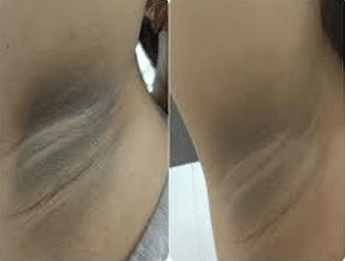 dark underarms before and after lightening