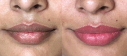 how to lighten dark lips fast