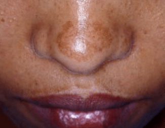 what causes black patches on face