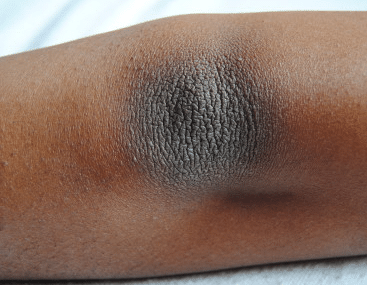 what causes dark elbows