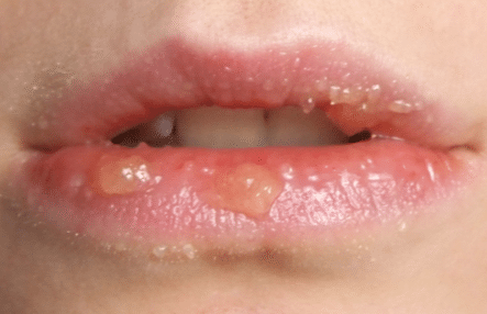 white patches on lips