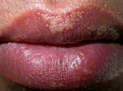 white spots on lips - Fordyce