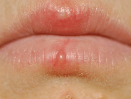 white spots on lips - pictures