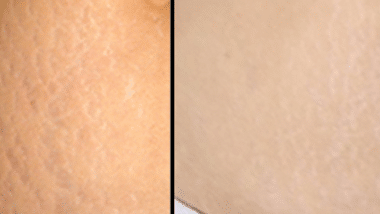 coconut oil for stretch marks before and after