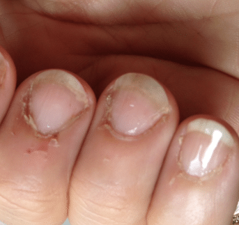 peeling fingers