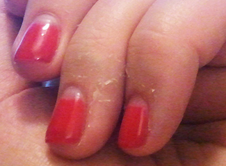 skin peeling on fingers