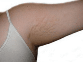 stretch marks on arms for no reason