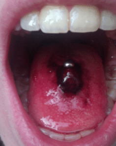 Does tongue piercing hurt