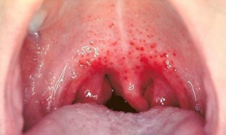 cropped Red spots on roof of mouth