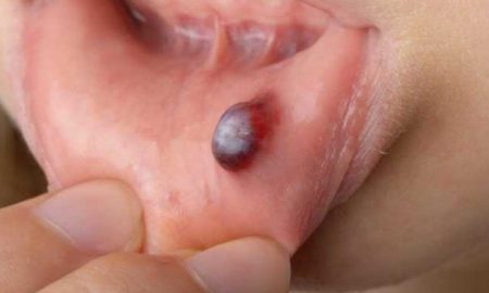 cropped blood blister