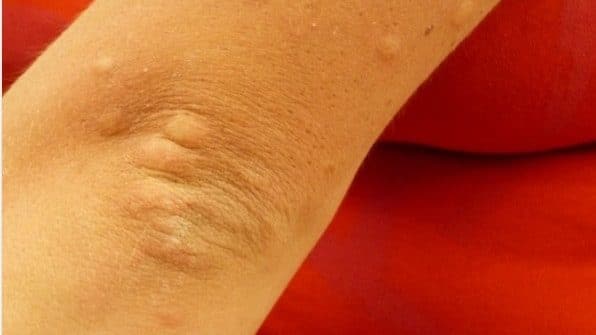 cropped bumps on elbows