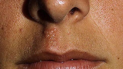 cropped coping with cold sores s herpes sore under nose