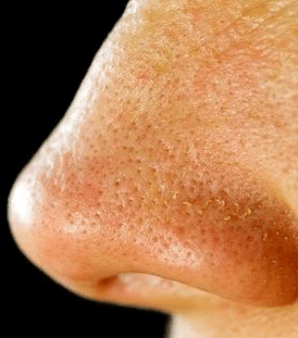 how to minimize large pores on nose
