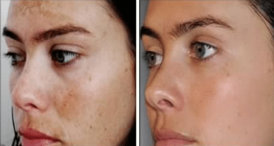 hydroquinone before and after skin 
