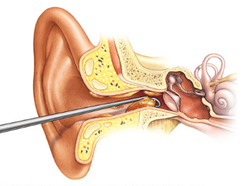 impacted ear wax removal