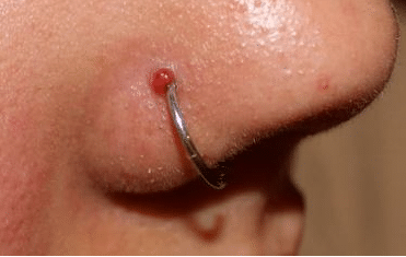 infected nose piercing