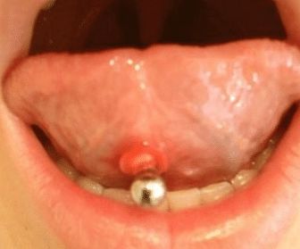 infected tongue piercing