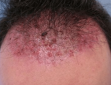 pimples on scalp under hair