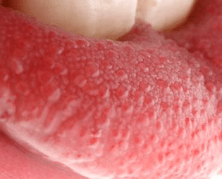 red bumps on tongue