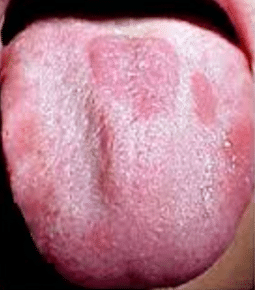red patches on tongue
