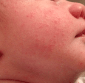 red rash on baby face