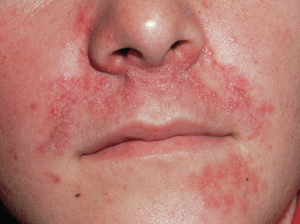 red rash on face