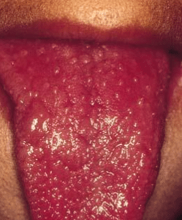 red spots on back of tongue