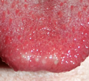 red spots on tip of tongue