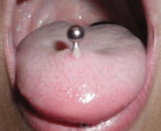 tongue piercing swelling image