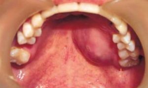 cropped A nodular submucosal tumor is noted on the left side of hard palate