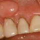 cropped Lump on Gum Picture