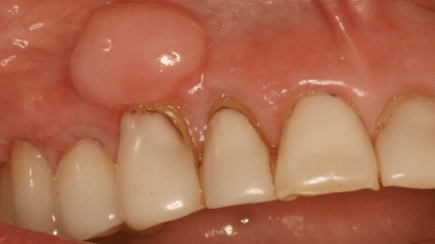 cropped Lump on Gum Picture