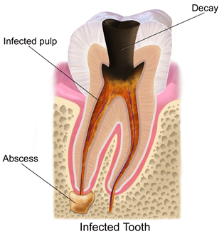 causes of a toothache