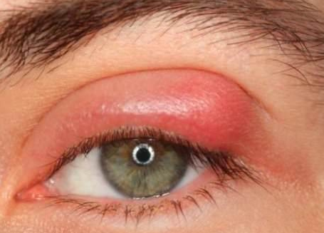 lump on eyelid picture