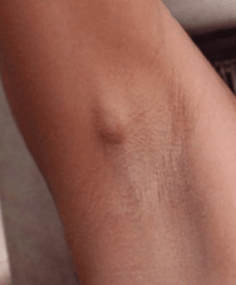 painful lump under armpit