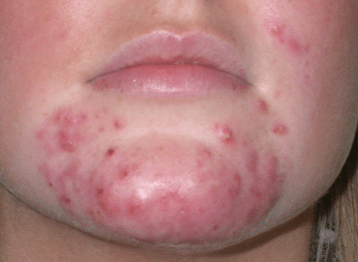 red bumps on chin - cystic acne