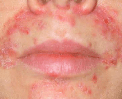 acne rash around mouth