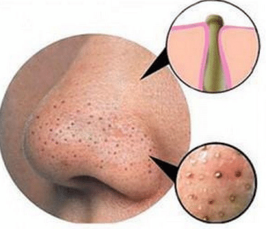 causes of blackheads on nose