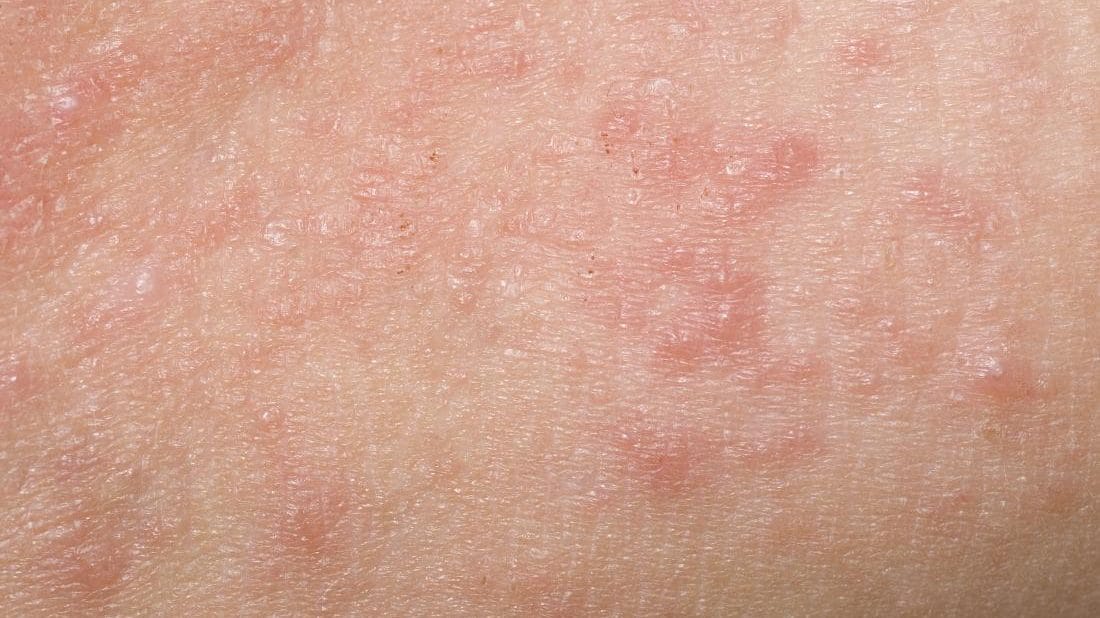 cropped close up of skin in rash
