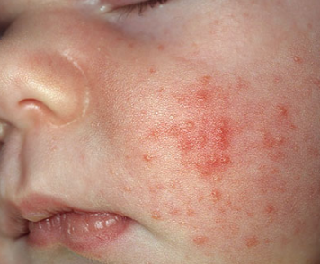 how to get rid of baby acne on face