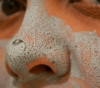 how to get rid of blackheads from nose