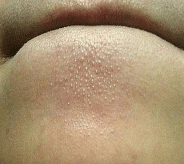 how to get rid of whiteheads on chin