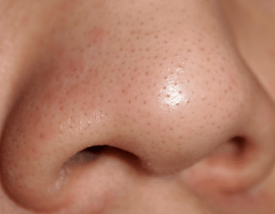 how to remove blackheads from on nose fast